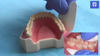 Technique for placing a resin fissure sealant [upl. by Brass]