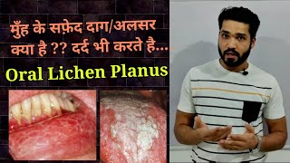 Oral lichen planus  appearance amp causes  kya oral lichen planus cancer hai [upl. by Schreck]