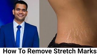 How To Remove Stretch Marks Fast  Home Remedy [upl. by Zed862]