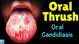 Oral Thrush  Oral Candidiasis – Symptoms Causes Diagnosis Treatment Complications [upl. by Aylat]