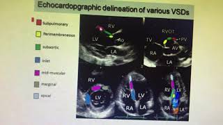 Echocardiogram division of types of VSD [upl. by Nilkcaj8]