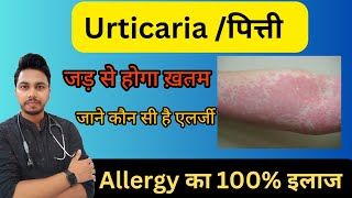 पित्ती ठीक करने की सबसे बेहतरीन दवा  Urticaria Causes Symptoms Treatment urticaria [upl. by Campball]