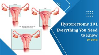 Hysterectomy 101 Everything You Need to Know Before and After the Procedure [upl. by Massey]