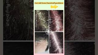 Best Pharmacy Shampoo for Dandruff free Hairspharmacy haircare dandruff ytshorts shorts [upl. by Alrich]