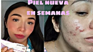 Tretinoina antes y despues manchas y acne● [upl. by Ellita]