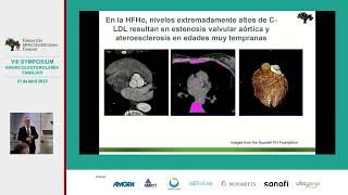 Hipercolesterolemia Familiar Homocigota Actualización en el diagnóstico y tratamiento [upl. by Ainitsirhc]