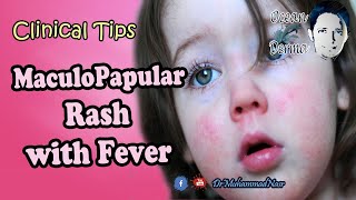 MaculoPapular Rash with Fever  Ocean Derma  Clinical Tips [upl. by Ssac]