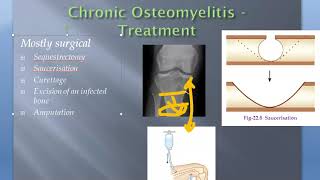 Orthopedics Pyogenic Osteomyelitis Treat Acute Chronic Saucerization [upl. by Pelaga]