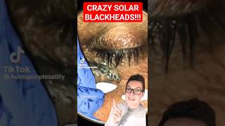 Crazy BLACKHEAD REMOVAL  Extreme Solar Comedones shorts [upl. by Eselehs]