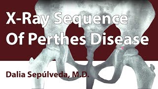 XRay Sequence Of Perthes Disease [upl. by Zebe964]