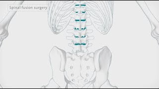 MAS® TLIF Patient Animation [upl. by Cousins87]