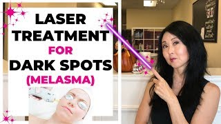 Laser Treatment for Dark Spots Melasma [upl. by Anatak]