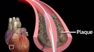 Heart Stent Surgery [upl. by Lucas62]