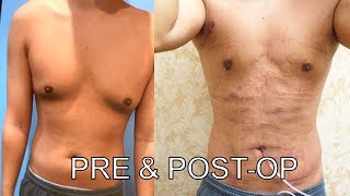 GYNECOMASTIA Surgery 48 hrs PostOP Results BEFORE AND AFTER 🔥  Dr Lebowitz [upl. by Hussein395]