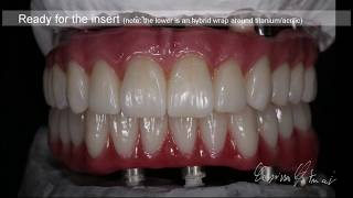 Zirconia Monolithic Full Implant Bridge Tutorial [upl. by Aloise543]