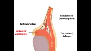 Epididymitis [upl. by Kilam]