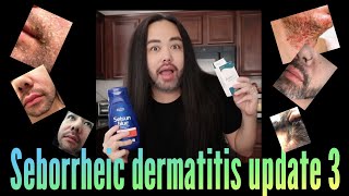 Seborrheic Dermatitis  Update 3 [upl. by Harold]