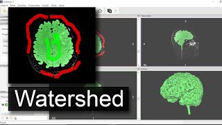 InVesalius  Tutorial 4  Watershed [upl. by Kathe]