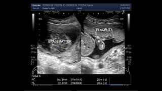 Ultrasound Video showing Anencephaly in a Pregnancy of about 20 weeks [upl. by Bonney741]