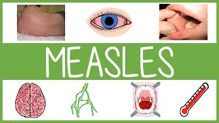 Measles  Features Management and Mnemonics [upl. by Phillipp110]