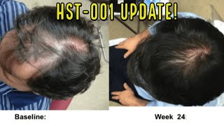 HISTOGEN HST001 STEM CELL HAIR LOSS TREATMENT UPDATE RECRUITING FOR PATIENTS [upl. by Gausman601]