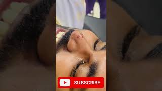 Laser Mole Removal  Mole तिल kaise nikale shortvideo viral doctor hospital skincare mole [upl. by Roose703]