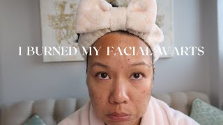 BURNING OFF MY FACIAL WARTS AT HOME  DIY WART REMOVAL [upl. by Sillyrama367]