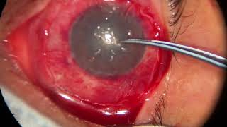 Simple Epithelial Limbal Transplant  Trasplante Simple de Células Limbares [upl. by Selrahc222]