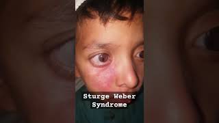 Sturge Weber Syndrome eyes ophthalmology optometry [upl. by Irish405]