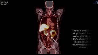 PSMA PET CT F18 Pylarify Case 3 [upl. by Notsua581]