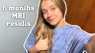 6 Months After Brain Surgery  MRI results  health update [upl. by Deena]