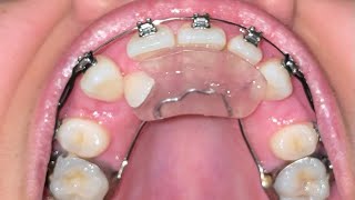 Upper Braces Time Lapse  15 Month Update  Adult Braces [upl. by Lanctot]