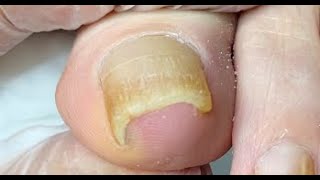 Thick nail curved into toe and relief in 1 minute [upl. by Hedve]