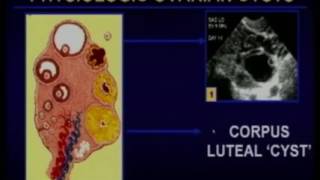 Sonographic Evaluation of the Ovary To Worry or not to Worry [upl. by Lawry]