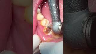 Tooth caries dentist dental viralvideo [upl. by Eide]