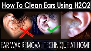 Ear Wax Removal Technique at Home  How To Clean Ears Using Hydrogen Peroxide [upl. by Notyalc]