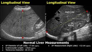 How To Measure Liver On Ultrasound  Craniocaudal Length Transverse Volume amp AP Measurements USG [upl. by Martynne]