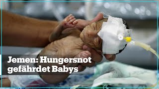 Jemen Hungersnot gefährdet Babys [upl. by Euqirdor]