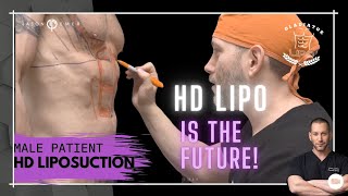 Male Gladiator 360 HD Lipo amp Tummy Tuck The FUTURE Is With HD Liposculpture  Dr Jason Emer [upl. by Zippora]