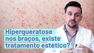 Tratamento estético para HIPERQUERATOSE NOS BRAÇOS  Pergunte 119 [upl. by Piane]