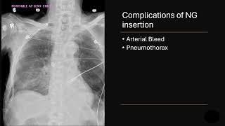 NG tube complications [upl. by Eulalee56]