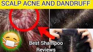 Dandruff amp Itching Shampoo Review – What Really Works [upl. by Llennoj]