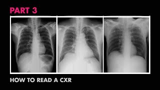 How XRays Work  How to Read a Chest XRay Part 3  MEDZCOOL [upl. by Naitsirhc487]