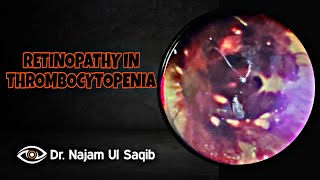 Retinopathy In Thrombocytopenia Indirect Ophthalmoscopy [upl. by Aicyla]