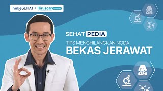 Tips Menghilangkan Noda Bekas Jerawat [upl. by Nappie]