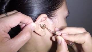 Womans Earwax Finally Removed after 25 Years [upl. by Shoshana]