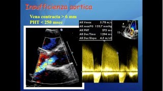 Elementi di ecocardiografia VII video valvulopatia aortica [upl. by Hamlani37]