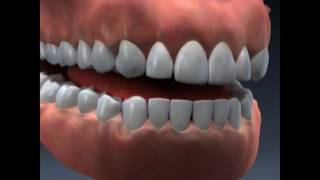 Abfraction  Lake Merritt Dental Oakland CA [upl. by Aihsot]