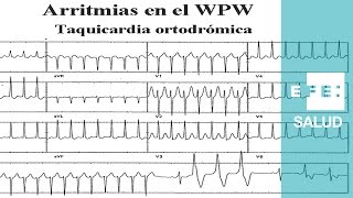 Taquicardia Arritmias paroxísticas las inesperadas [upl. by Nerrak]