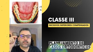 O que você precisa saber sobre Planejamento da Classe III Mandibular [upl. by Neale]